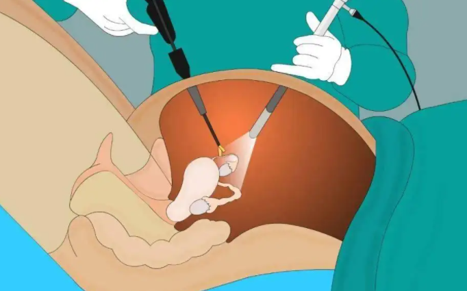 卵巢早衰后可以做试管婴儿吗？用捐赠的卵子做试管婴儿的费用是多少？